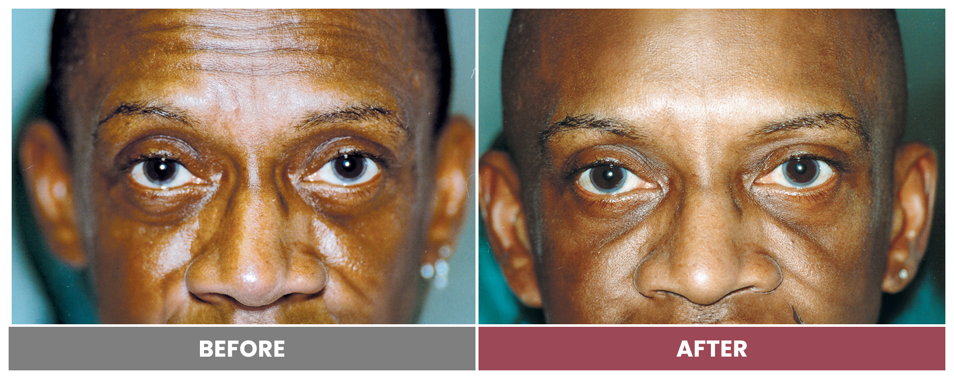 BOTOX FOR WRINKLES & BROW LIFT - Case 2